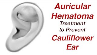 Auricular Hematoma Treatment to Prevent Cauliflower Ear [upl. by Notak]