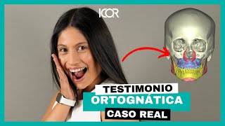 Mi testimonio de cirugía ortognática Clase II Implantes Ortodoncia  ICOR [upl. by Amihc]