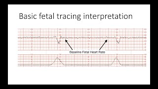 Interpreting Intrapartal fetal heart rate tracings [upl. by Alikat170]