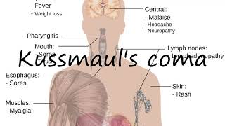 How to Pronounce Kussmauls coma [upl. by Stockton]