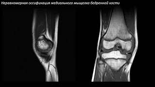 Анатомия и повреждение хряща коленного сустава и остеохондральные повреждения Учеваткин АА часть 4 [upl. by Eelloh]