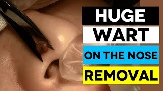 HUGE Wart On The Nose Facial Wart Removal [upl. by Xever]