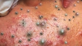 Big Cystic Acne Blackheads Extraction Blackheads amp Milia Whiteheads Removal Pimple Popping  5714 [upl. by Woody444]