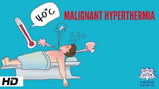 MALIGNANT HYPERTHERMIA Causes Signs and Symptoms Diagnosis and Treatment [upl. by Baerl106]