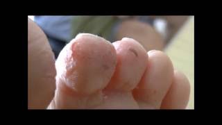 severe case of Athletes Foot before and 6 days after starting treatment [upl. by Innoc]