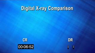 Digital X ray Comparisonwmv [upl. by Harbison]