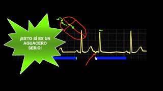 CURSO DE ELECTROCARDIOGRAFIA 47  EXTRASÍSTOLES SUPRAVENTRICULARES [upl. by Yrrum]