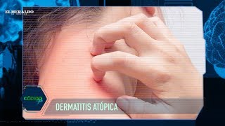 ¿Qué es y cómo tratar una dermatitis atópica [upl. by Jerad]