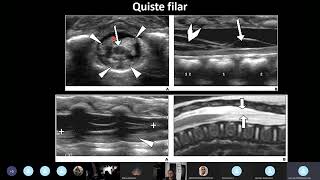 Ecografía de la Columna Neonatal parte 1 [upl. by Everick]