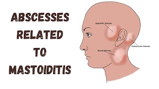 Abscesses related to mastoiditis  Complications of otitis media [upl. by Salamanca]