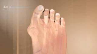 La correction de lhallux valgus et de ses complicationsDr Coillard  Dr Boublil  Dr Grisard [upl. by Kilk]