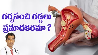 గర్భసంచి గడ్డలు ప్రమాదకరమా  Are uterinefibroids dangerous [upl. by Sibylla]