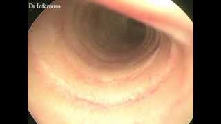 laryngoscopy and tracheoscopy [upl. by Eleonora832]