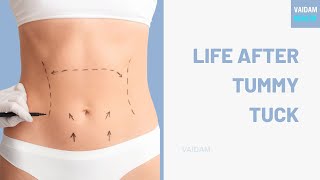 Life after Tummy Tuck [upl. by Retep152]