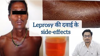 Leprosy की दवाई के sideeffects  Clofazimine  Hansepran  Rifampicin leprosy clofazimine कुष्ट [upl. by Anniram]