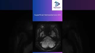 Superficial HemosiderosisSuperficialHemosiderosisNeuroRadiologyMRIImaging SusceptibilityMRI [upl. by Anippesuig]