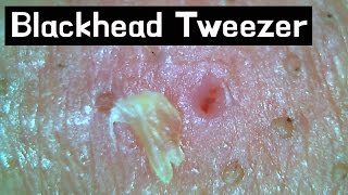 18 Pull out Blackheads  Whiteheads Close up 300X  Blackheads Removal [upl. by Godwin]