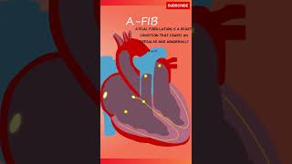 Atrial Fibrillation Sound  Heartbeat Sound and Explanation heartbeat atrialfibrillation [upl. by Andeee872]