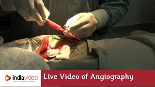 Live Video of Angiography at Lisie Hospital  How angiography is done [upl. by Oilenroc938]