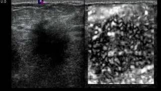 Ultrasound elastography may help women avoid breast biopsy [upl. by Eniamert]