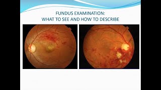 Fundus examination Volk lens direct ophthalmoscopy and binocular indirect ophthalmoscopy [upl. by Yenahs]