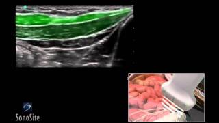 How To Ilioinguinal and Iliohypogastric Regional Nerve Block 3D Video [upl. by Trip]