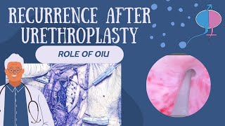 Role of OIU in Stricture after Urethroplasty [upl. by Bettzel]