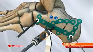 ORTHOLOC CALCANEAL FRACTURE PLATING SYSTEM [upl. by Moreland]