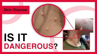 Molluscum contagiosum  Symptoms Risk factors Treatment Prevention  Dermatology [upl. by Agace]