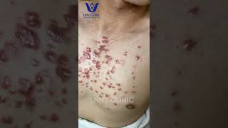 ĐIỀU TRỊ SẸO LỒI  Keloid  HIỆU QUẢ SAU TỪNG BUỔI  TẠI PHÒNG KHÁM DA LIỄU HHV CLINIC [upl. by Hadsall722]