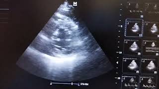 Global hypokinesia of left ventricle improved after Rx in PSAX echo view at mid ventricular level [upl. by Ziana]