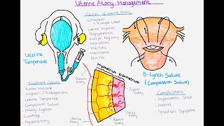 Understanding Uterine Atony and Ways to Treat it Postpartum Haemorrhage [upl. by Nsaj]