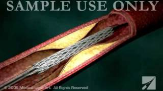 Stent Angioplasty  ANC00202 [upl. by Srevart983]