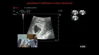 gravidanza alla settima settimana di gestazione [upl. by Bluhm936]