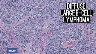 Diffuse Large BCell Lymphoma DLBCL [upl. by Feliza]