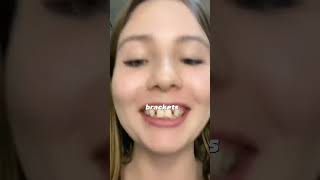 Agenesia dental dientes dentista tips parati viral fyp shorts shortvideo fypシ [upl. by Nive]