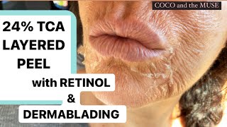 AT HOME BEST PEEL EVER 24 TCA RETINOL amp DERMAPLANE  VI Peel DUPE  Complete Procedure [upl. by Intirb]