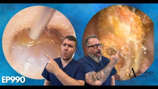 HUGE POLYPS PEELS amp MASSIVE EAR WAX PLUGS  EP990 [upl. by Adleme]