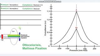 Tympanometry Tympanogram Impedance Tympanometry [upl. by Atteval]