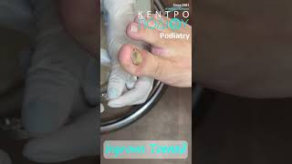 Ingrown Toenail κεντροποδιου kentropodiou podiatry podiatria podologia podology podiatrist [upl. by Niarda255]