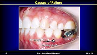 TADs 2018 Part 3 Stability and Complications Live in Arabic [upl. by Woodley96]