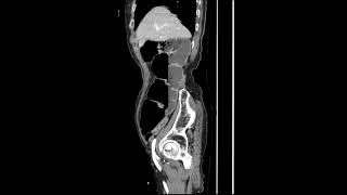 mechanical ileus [upl. by Normak]