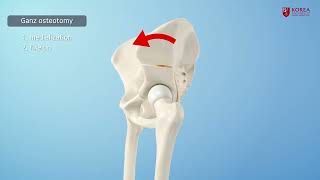 Pediatric pelvic osteotomy for dysplastic hip [upl. by Langham]