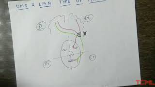 Upper and lower motor neuron type of facial palsy [upl. by Attennot384]