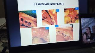 Preprosthetic surgery lecture part 1 [upl. by Eilyab7]