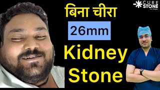 बिना चीरा 26mm का Kidney Stone निकला  Laser kidney Stone Treatment  RIRS  26 cm Stone Removal [upl. by Anis]