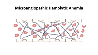 Microangiopathic Hemolytic Anemia [upl. by Reo]