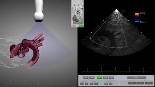 HeartWorks Aortic Dissection [upl. by Sgninnej295]