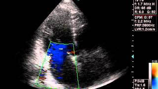 Echocardiography diagnosis eccentric mitral regurgitation [upl. by Glorianna409]