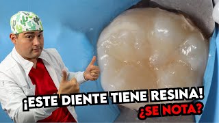 RESINAS DENTALES ANTES Y DESPUES ¿COMO DEBE QUEDAR UNA RESTAURACIÓN DENTAL CORRECTAMENTE [upl. by Ylrehs]